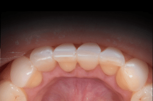 Astuce précision résine composite 8b