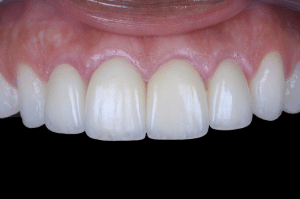 astuce ciment temporaire excès 2