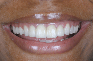 astuce excès ciment temporaire richelme 2