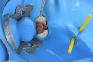 isolation carie sous gingivale (1)