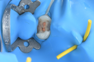 isolation carie sous gingivale (2)