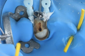 isolation carie sous gingivale (3)