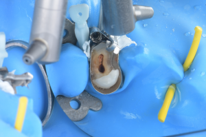 isolation carie sous gingivale (4)