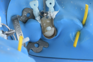 isolation carie sous gingivale (5)