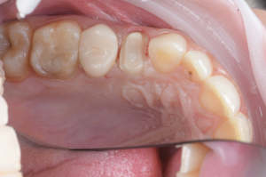 isolation carie sous gingivale (6)