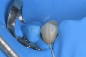 isolation carie sous gingivale (7)