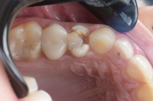 isolation carie sous gingivale