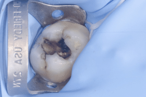 traitement d'une carie profonde