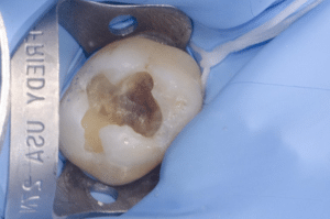 traitement d'une carie profonde