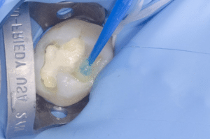 traitement d'une carie profonde