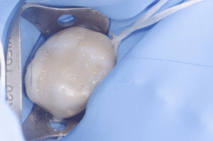 traitement d'une carie profonde