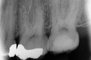 traitement d'une carie profonde