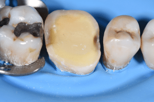 point de contact restauration partielle collée 1