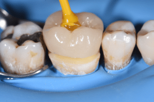 point de contact restauration partielle collée 2