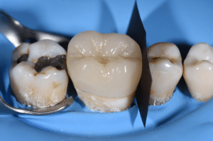 point de contact restauration partielle collée 3