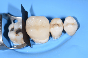 point de contact restauration partielle collée 4