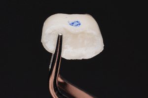 point de contact restauration partielle collée 5