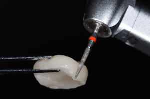 point de contact restauration partielle collée 6