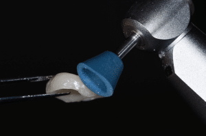 point de contact restauration partielle collée 7