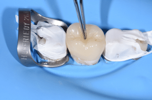 point de contact restauration partielle collée 8