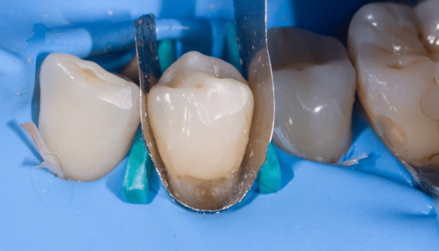 astuce isolation dentaire