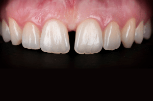 fermeture diasteme Filtek (1)