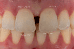 fermeture diasteme Filtek (2)