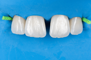 fermeture diasteme Filtek (3)