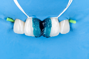 fermeture diasteme Filtek (4)