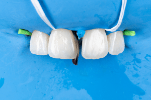 fermeture diasteme Filtek (5)