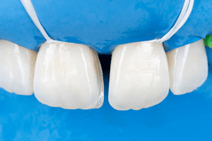 fermeture diasteme Filtek (6)