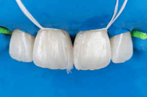 fermeture diasteme Filtek (7)