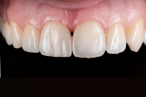 fermeture diasteme Filtek (8)