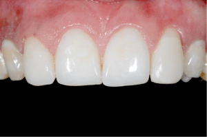 modification canine position latérale