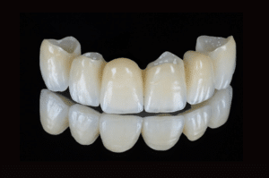 Élimination du ciment dans les embrasures lors du scellement (1)