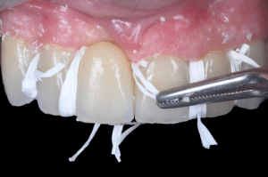 Élimination du ciment dans les embrasures lors du scellement (10)