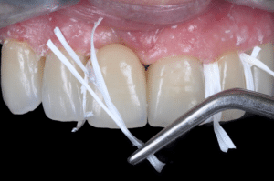 Élimination du ciment dans les embrasures lors du scellement (11)