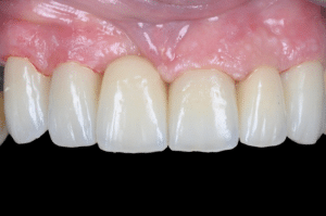 Élimination du ciment dans les embrasures lors du scellement (12)