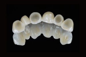 Élimination du ciment dans les embrasures lors du scellement (2)