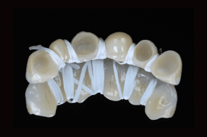 Élimination du ciment dans les embrasures lors du scellement (3)