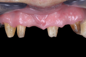 Élimination du ciment dans les embrasures lors du scellement (5)