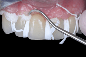 Élimination du ciment dans les embrasures lors du scellement (7)
