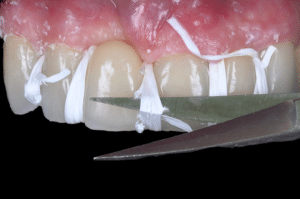 Élimination du ciment dans les embrasures lors du scellement (9)