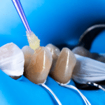 restauration postérieure céramique collée