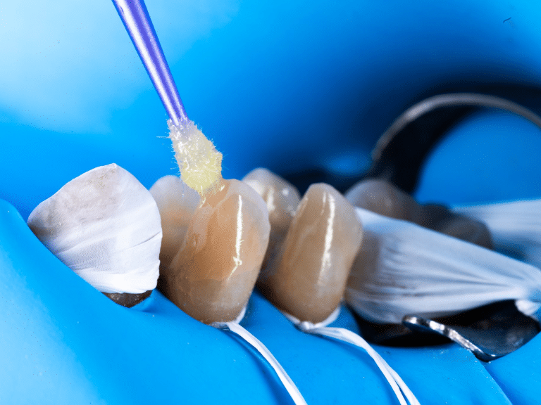 restauration postérieure céramique collée