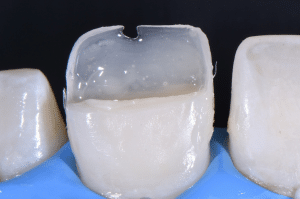 Maîtriser l’effet halo pour une stratification naturelle (3)