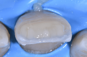 Maîtriser l’effet halo pour une stratification naturelle (4)