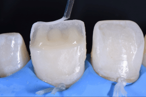 Maîtriser l’effet halo pour une stratification naturelle (6)