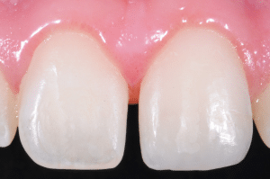 Maîtriser l’effet halo pour une stratification naturelle (8)